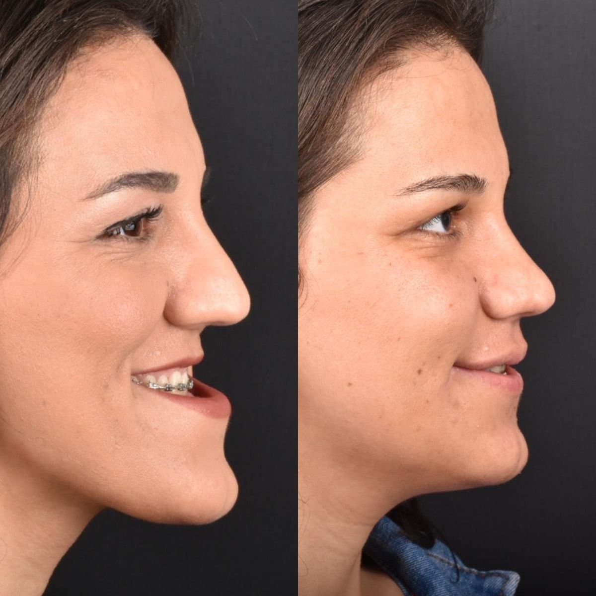 jaw implant