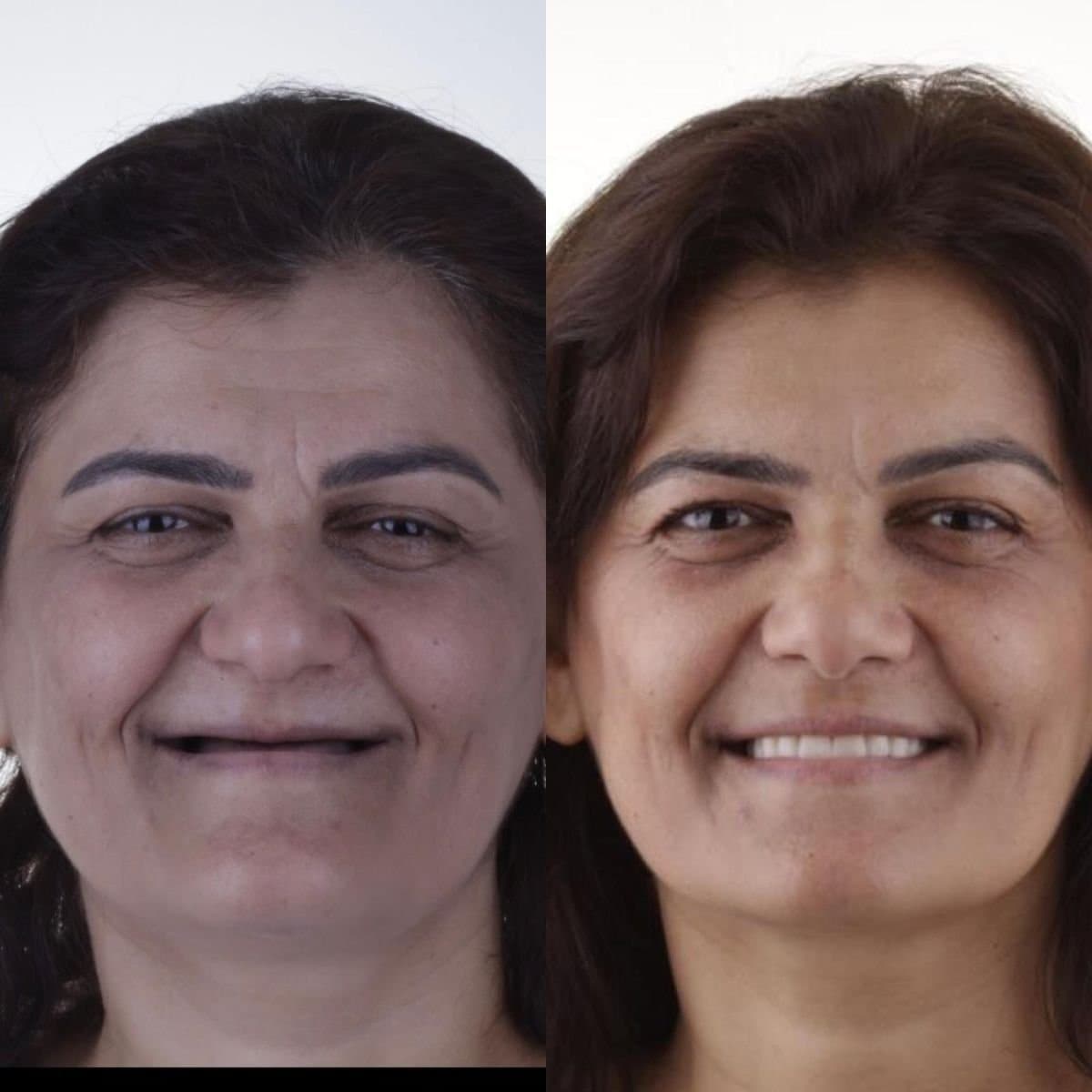 jaw implant