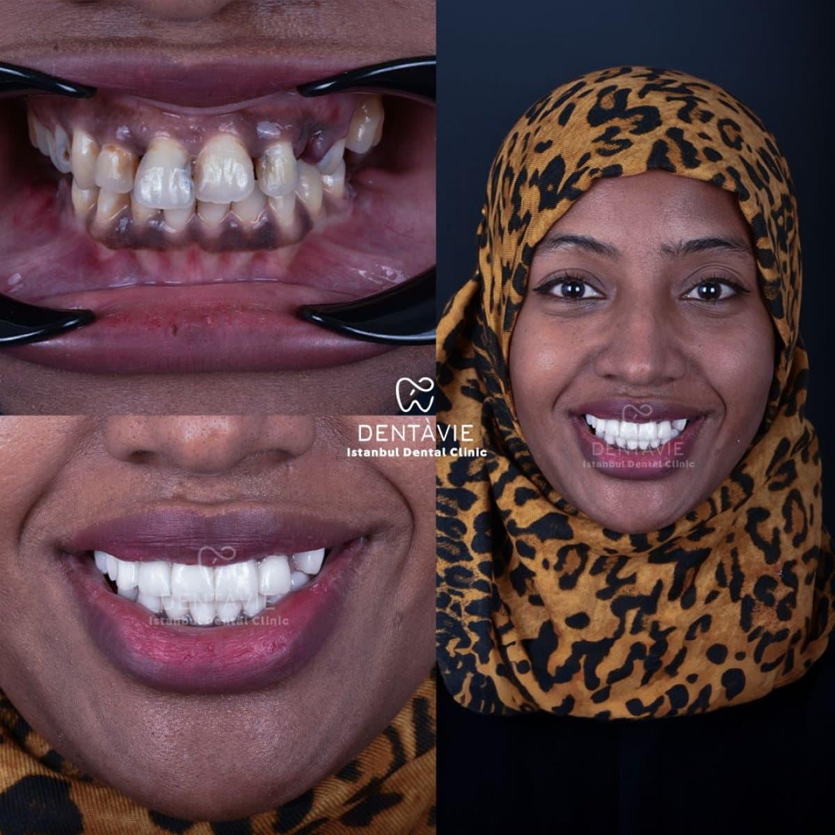 dental veneers