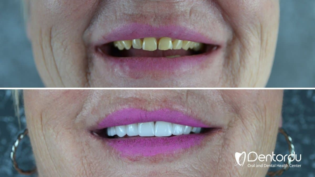 Hollywood Smile