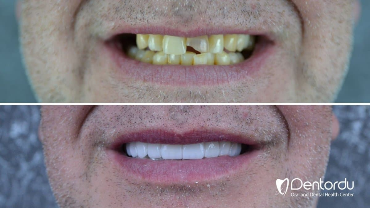 Hollywood Smile