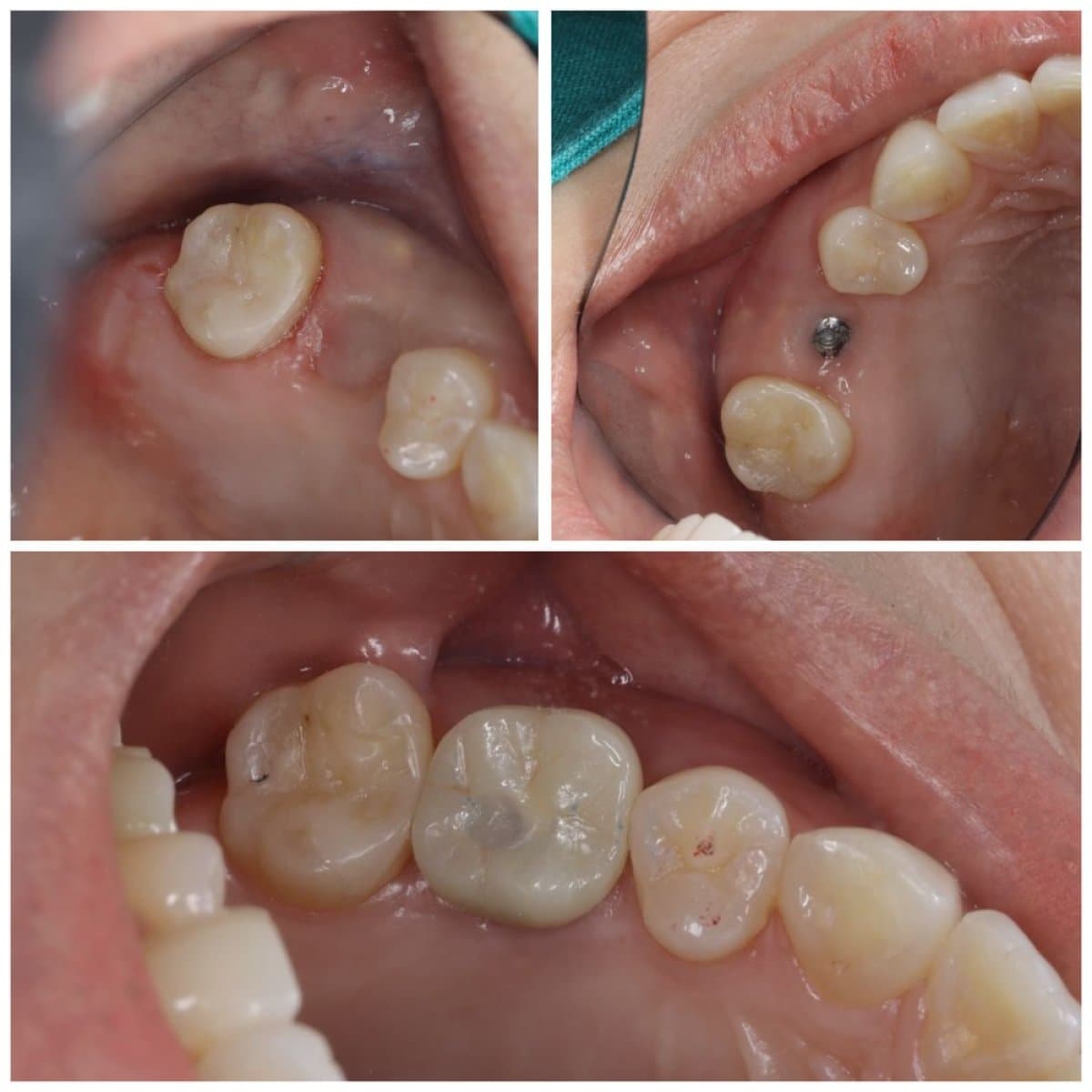 dental implant with crown
