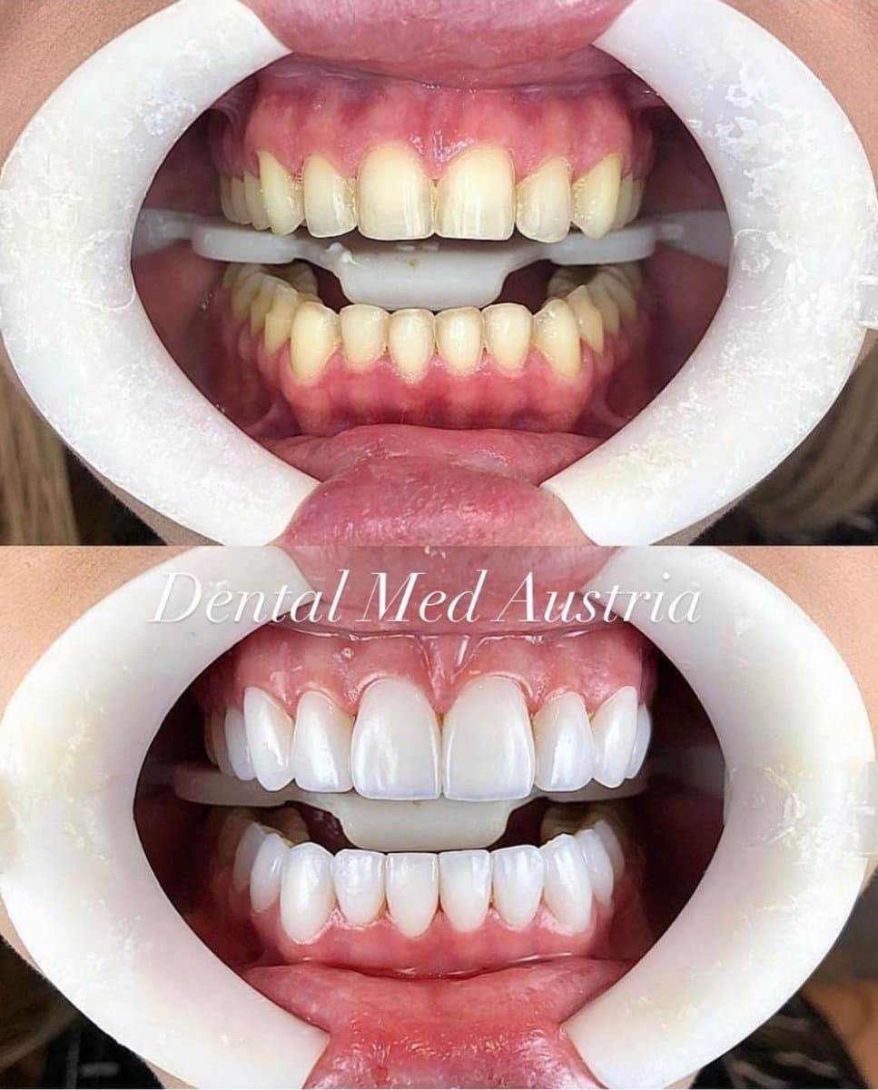 Hollywood Smile veneers