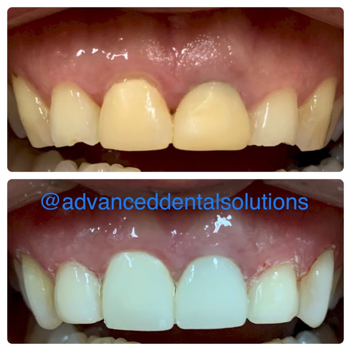 composite veneer