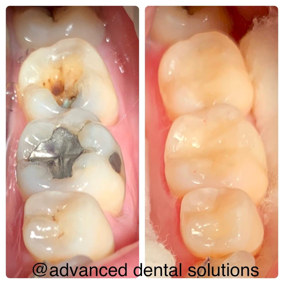 tooth restoration (bonding)