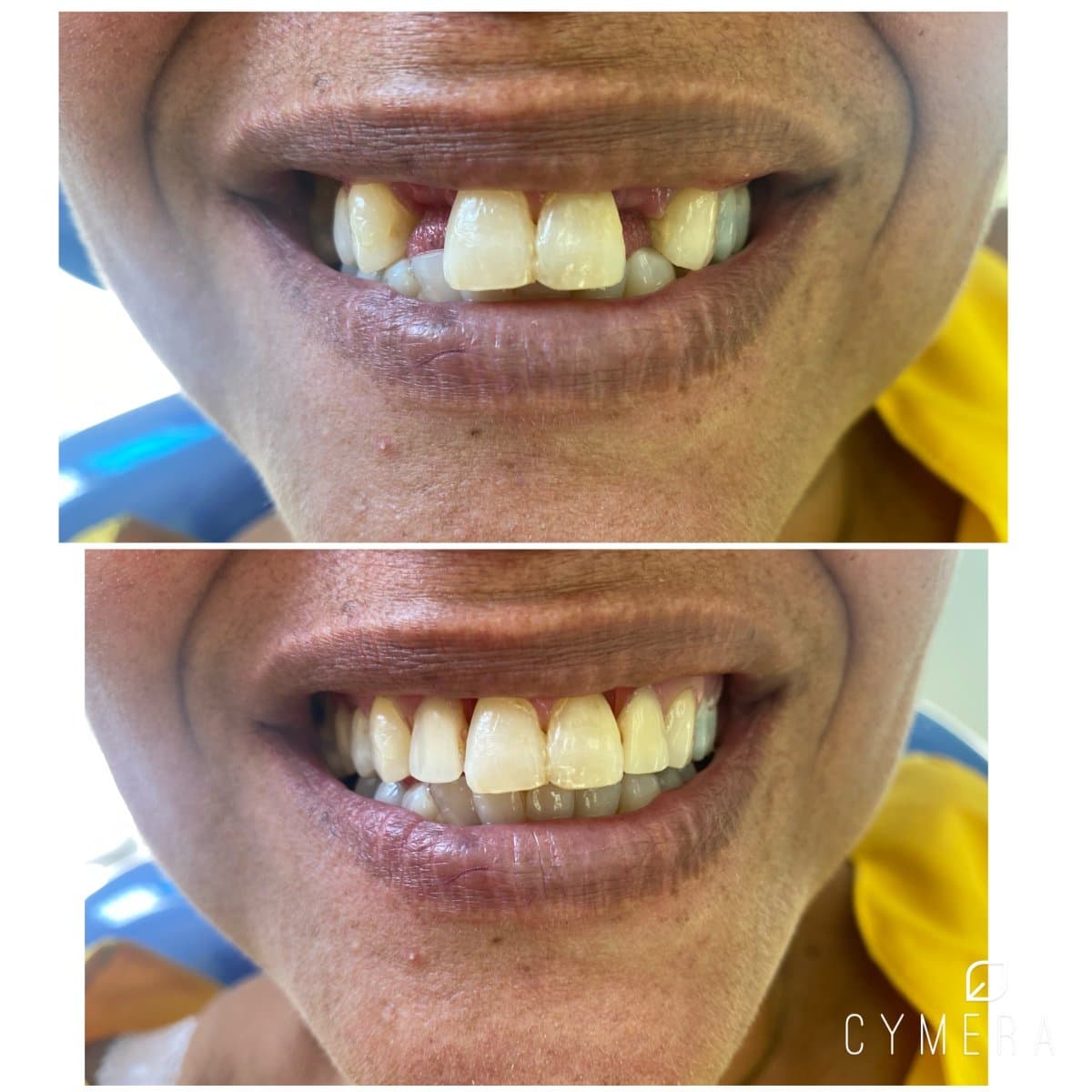 dental prosthetics installation
