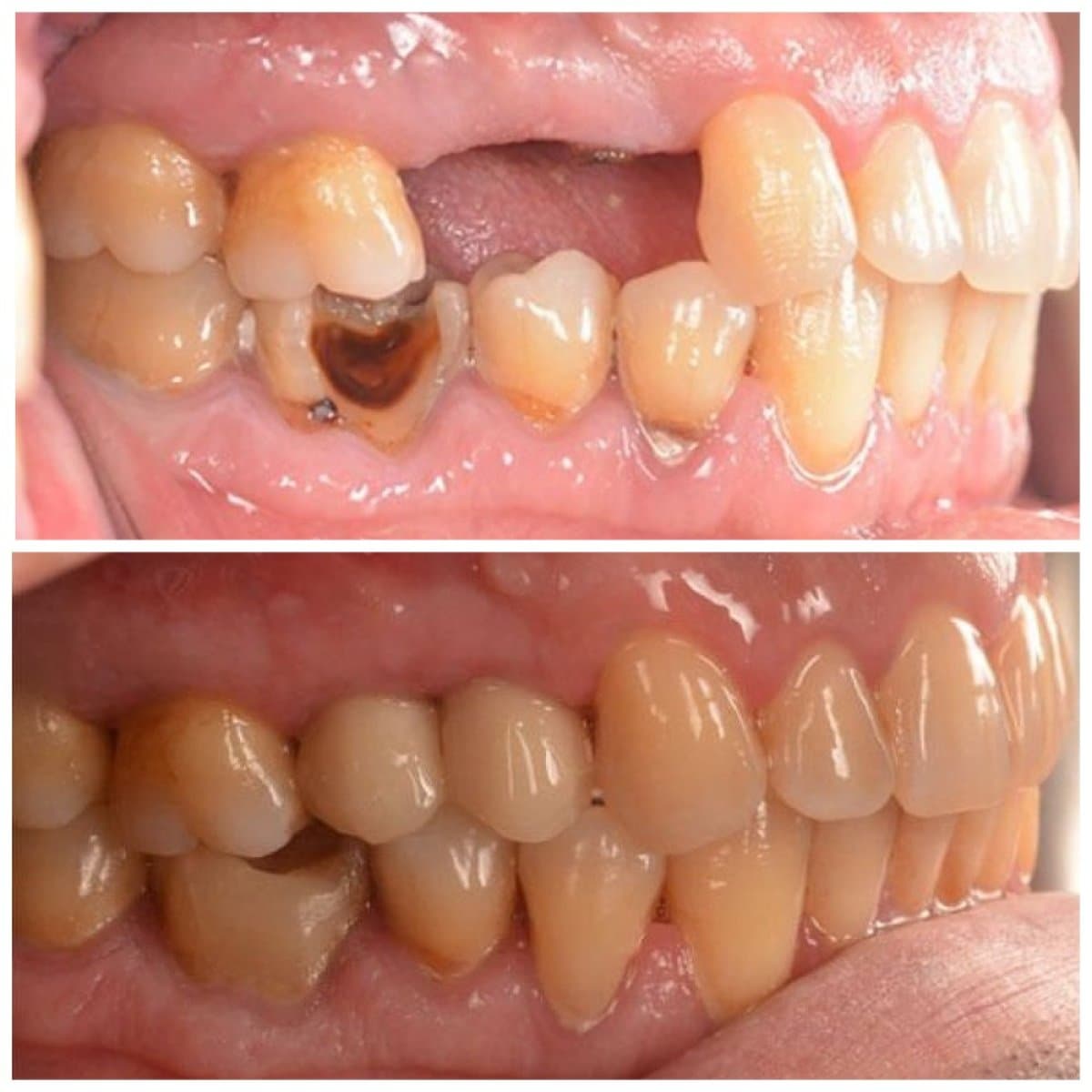 dental implant with crown