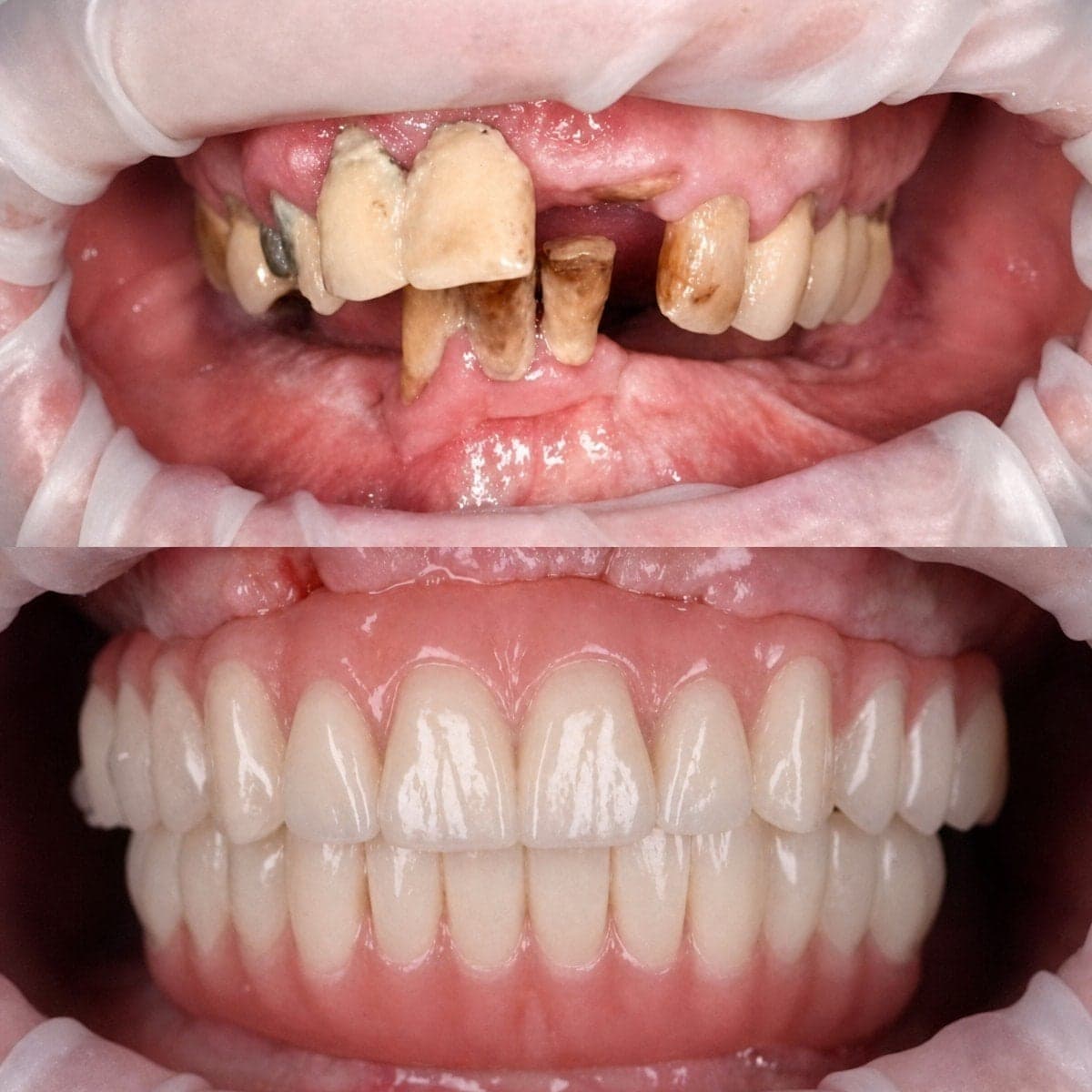 dental prosthetics installation