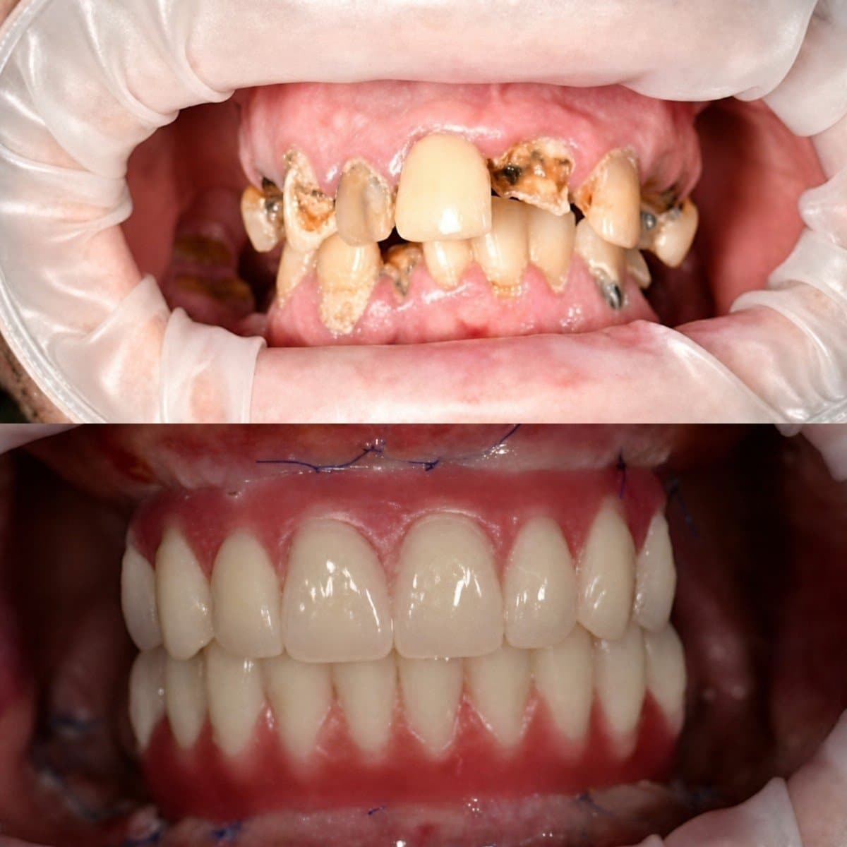 dental prosthetics installation