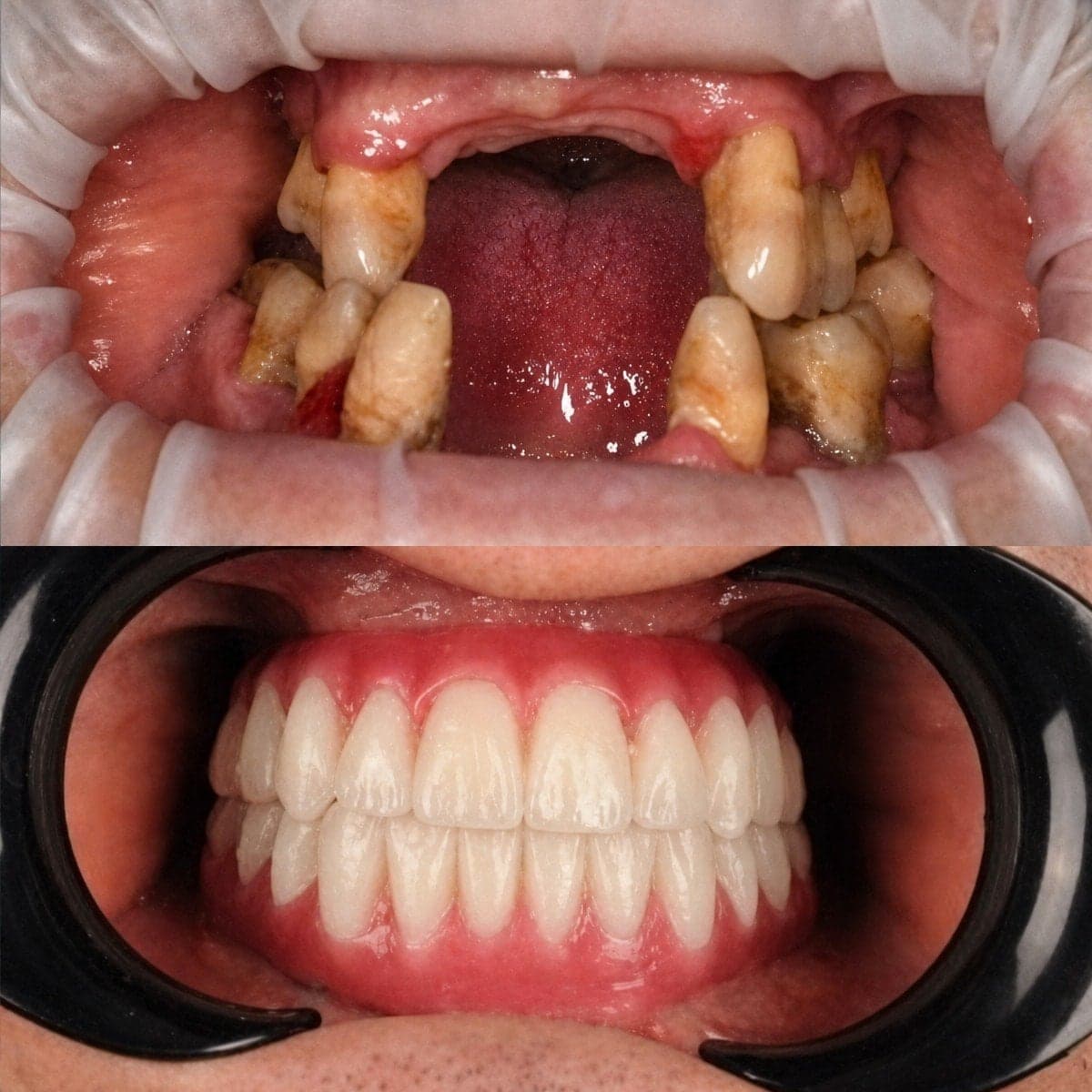 dental prosthetics installation