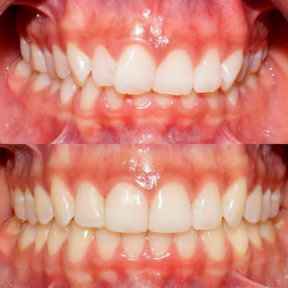 dental veneers