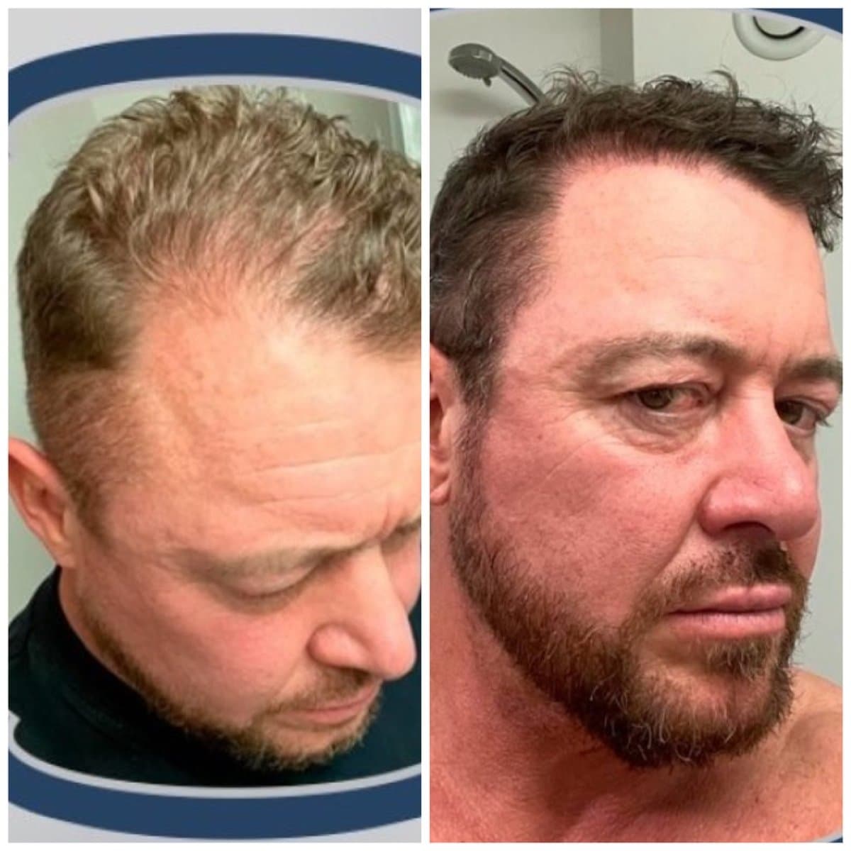DHI hair transplant
