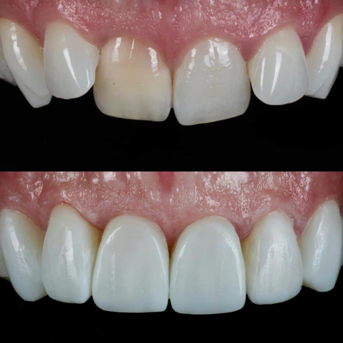 dental veneers