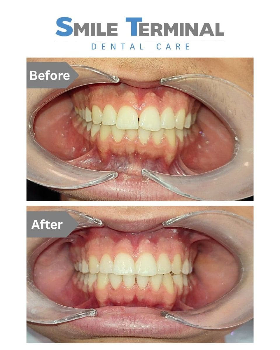 clear aligners