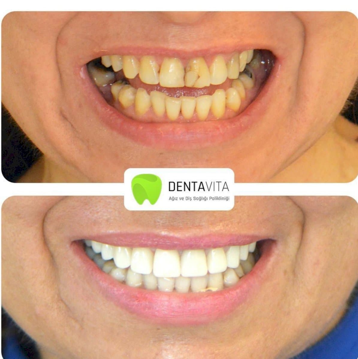 composite veneer
