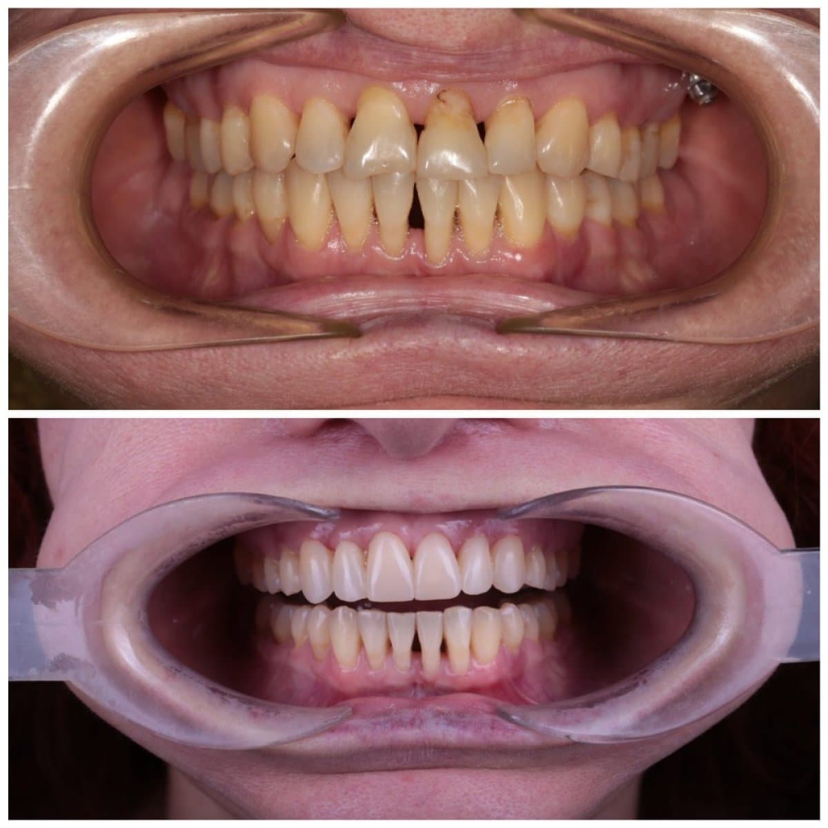 composite veneer