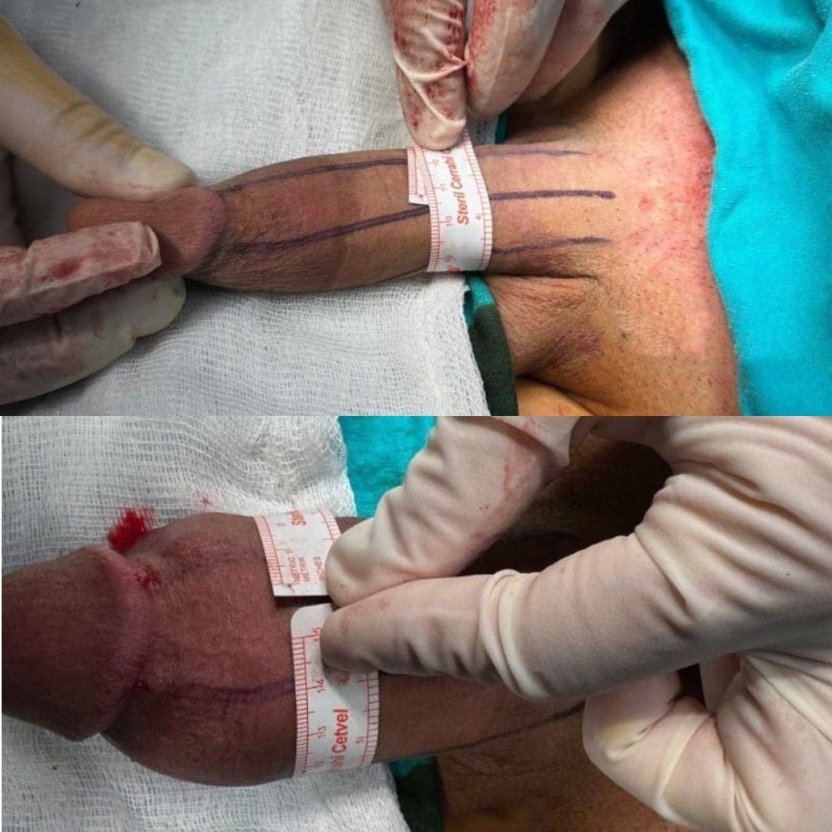 penile implant surgery