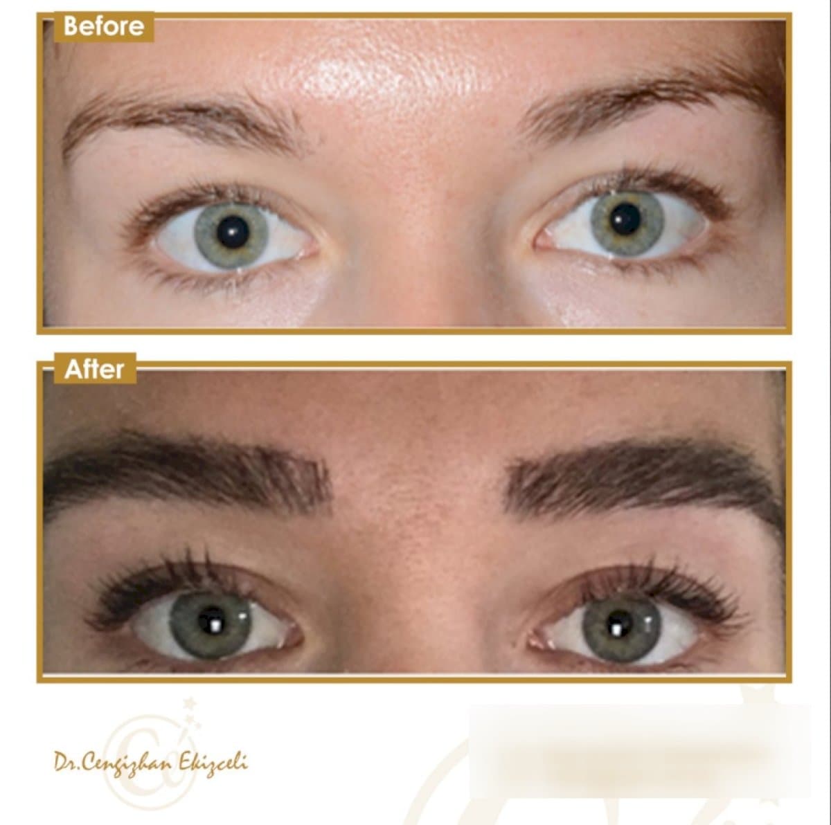 eyebrow transplantation