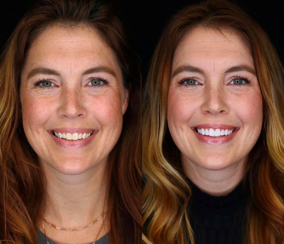 dental veneers