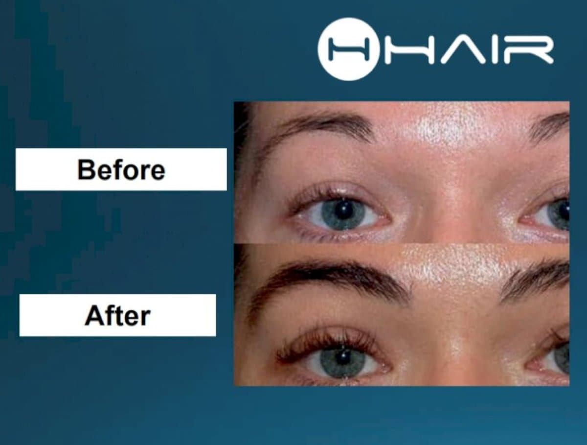 eyebrow transplantation