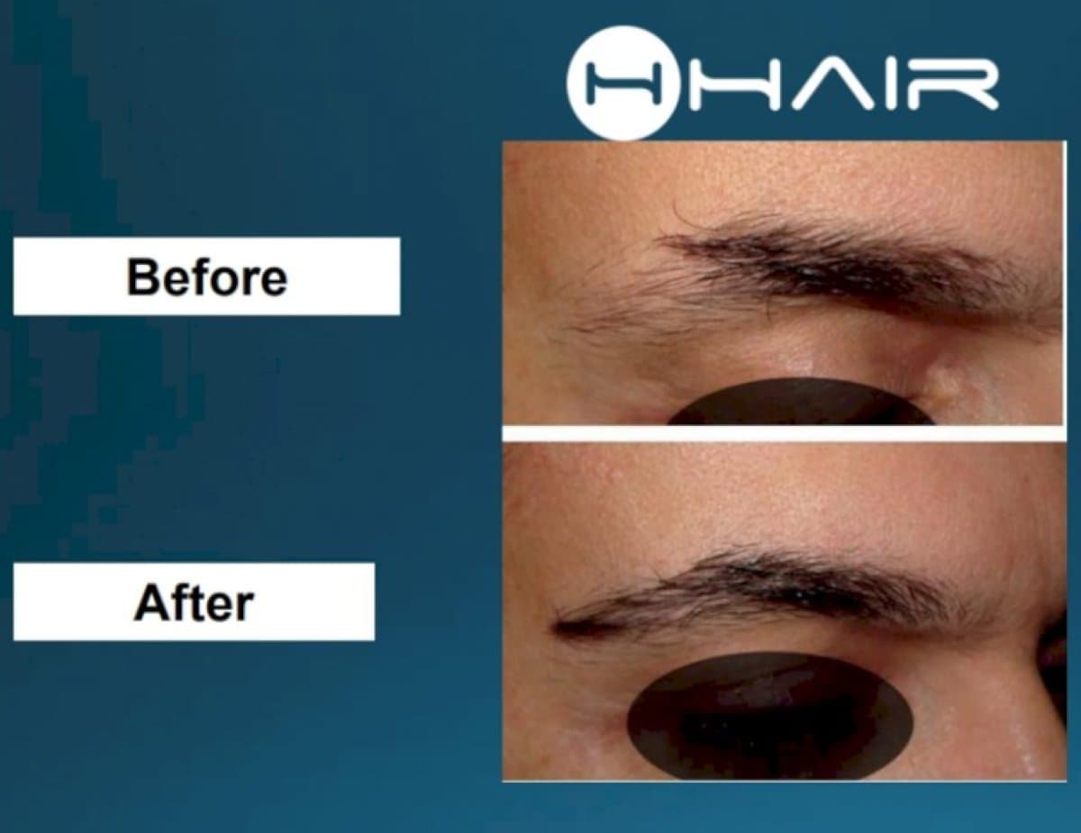 eyebrow transplantation