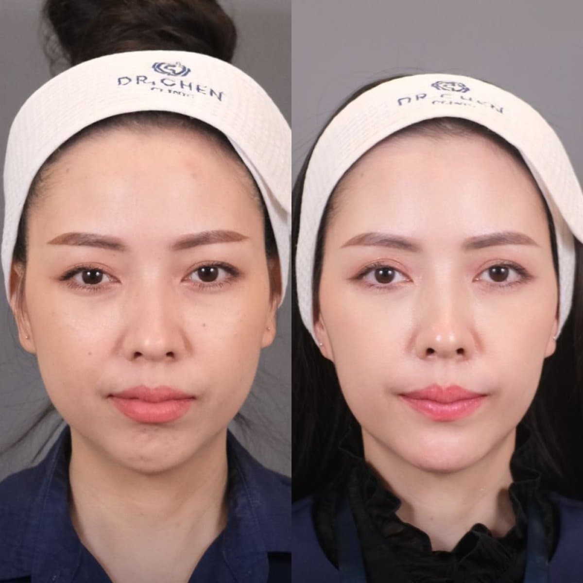 jawline contouring