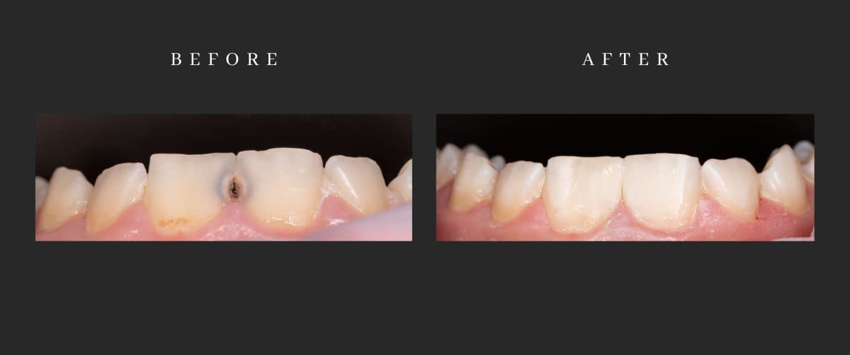 results of aesthetic composite filling