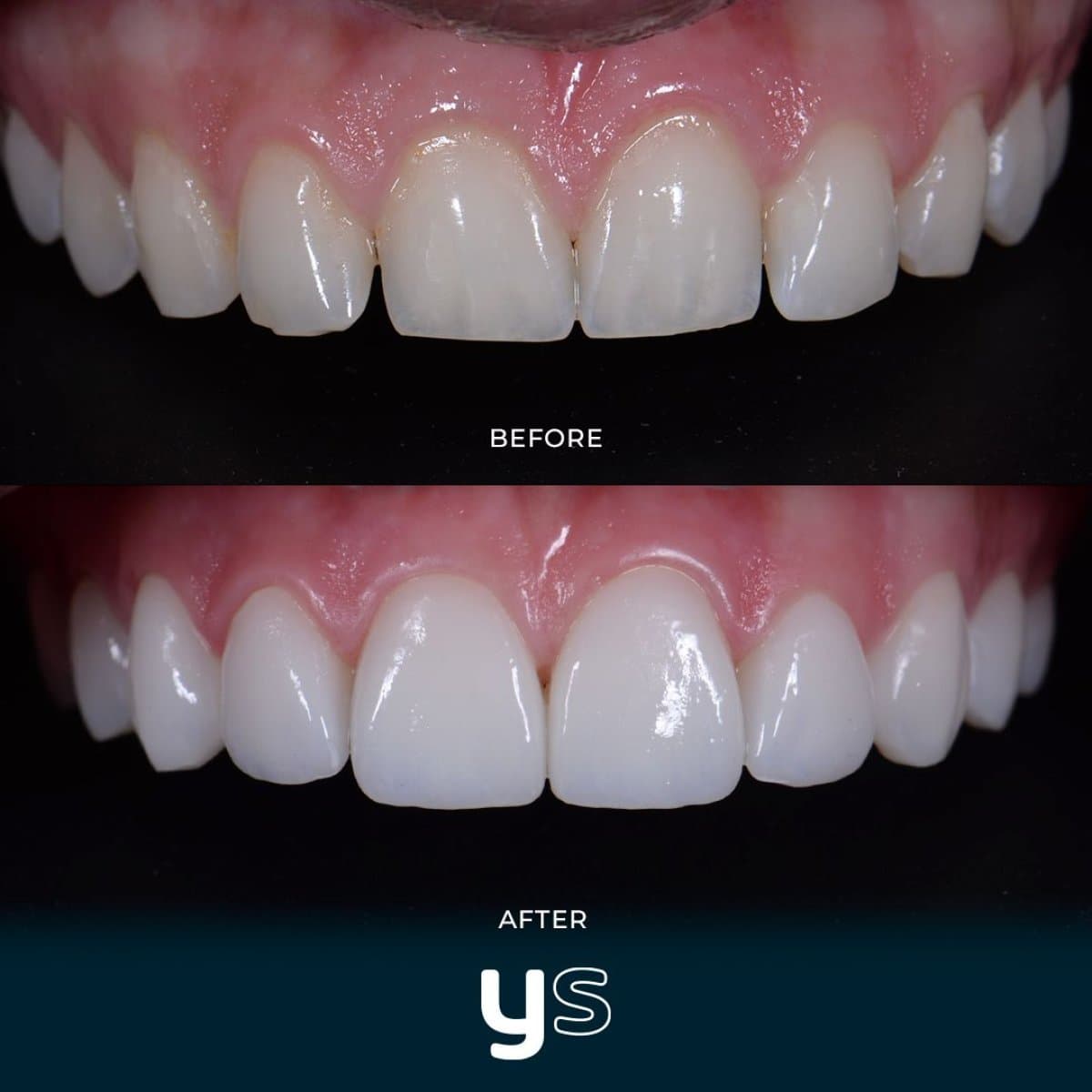 gum surgery