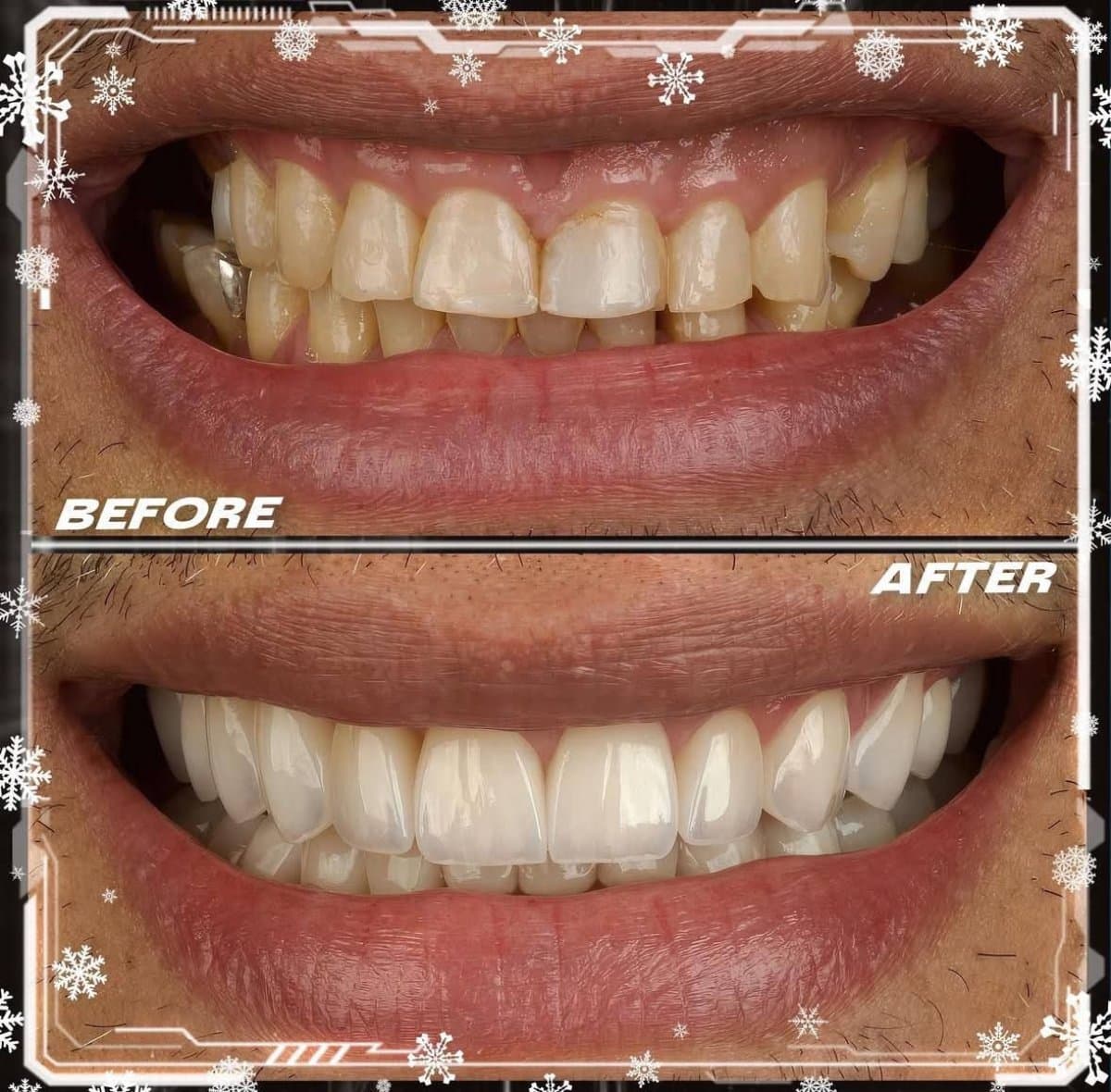 dental veneers