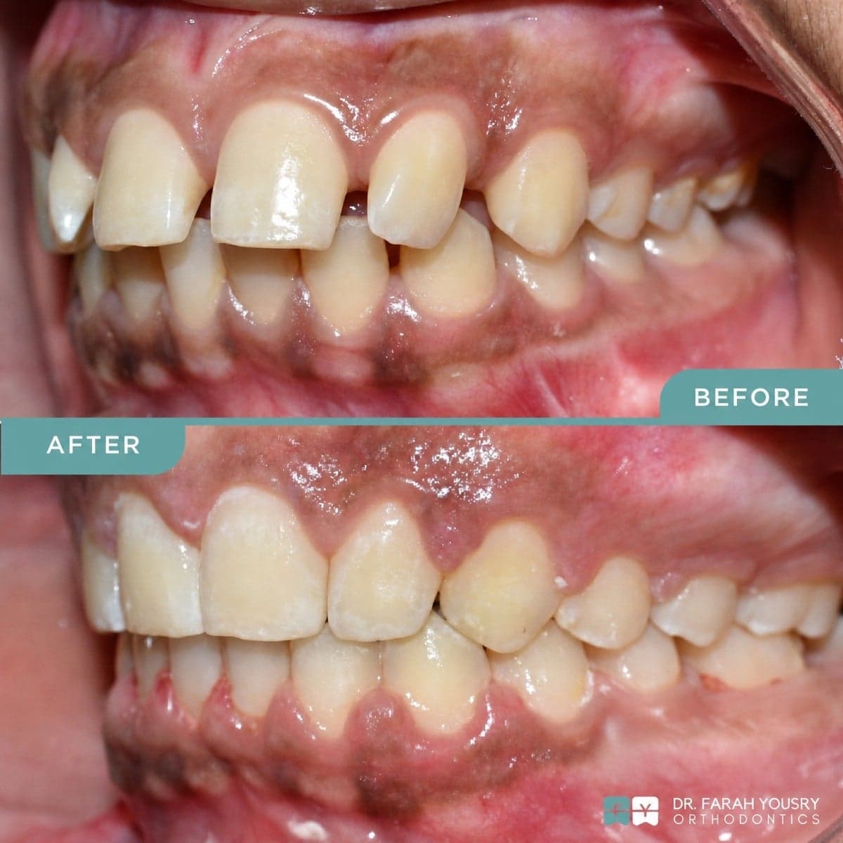 clear aligners