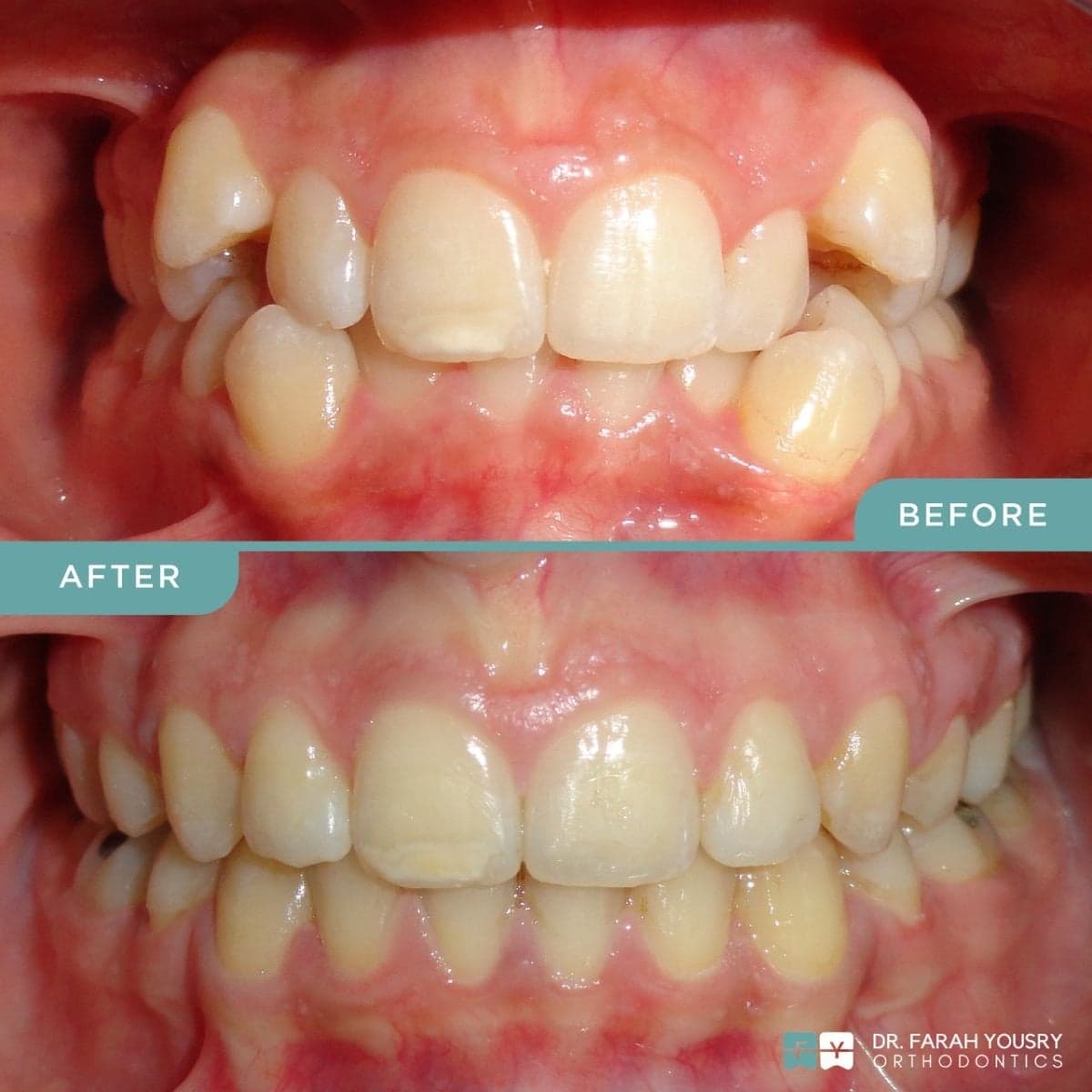 clear aligners