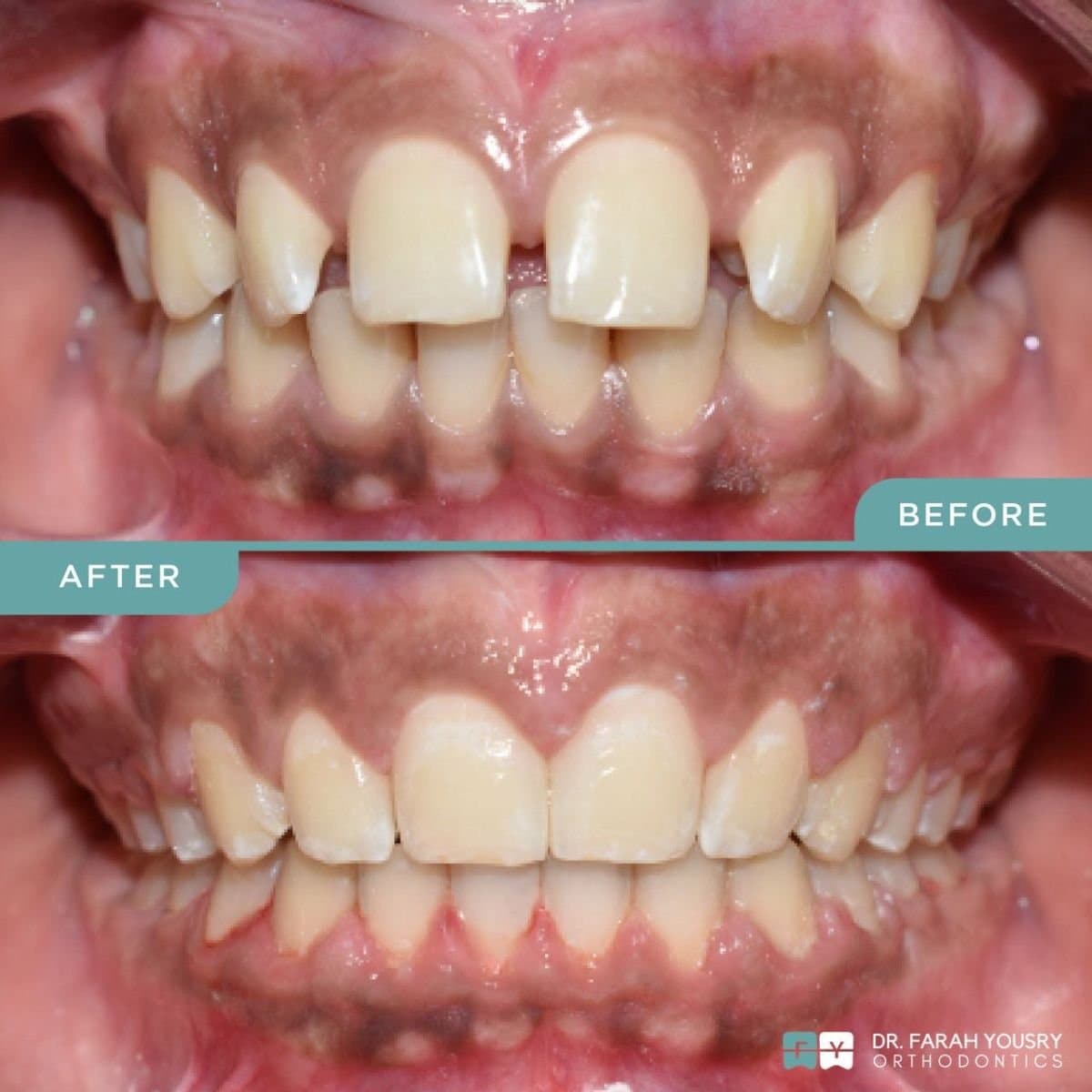 clear aligners