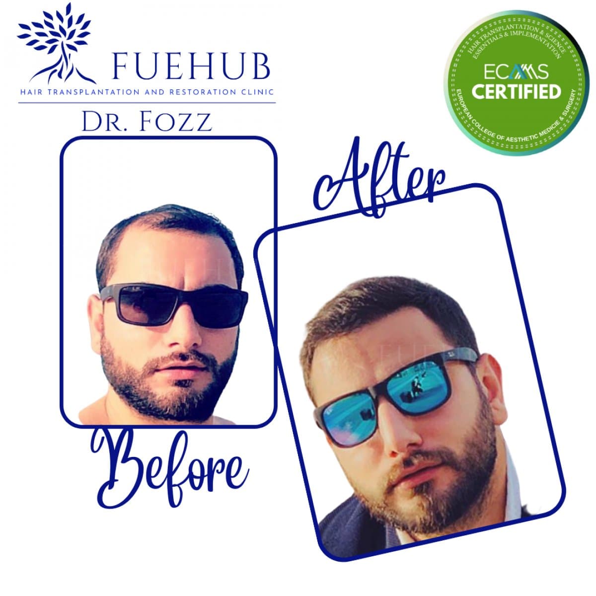FUE hair transplant