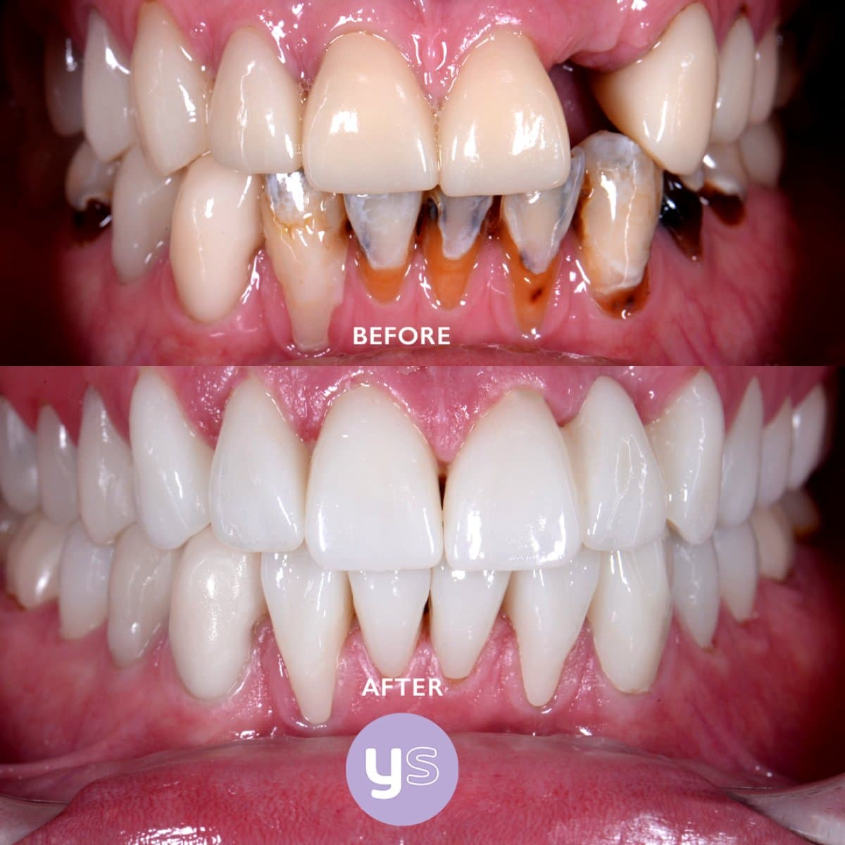 gum surgery