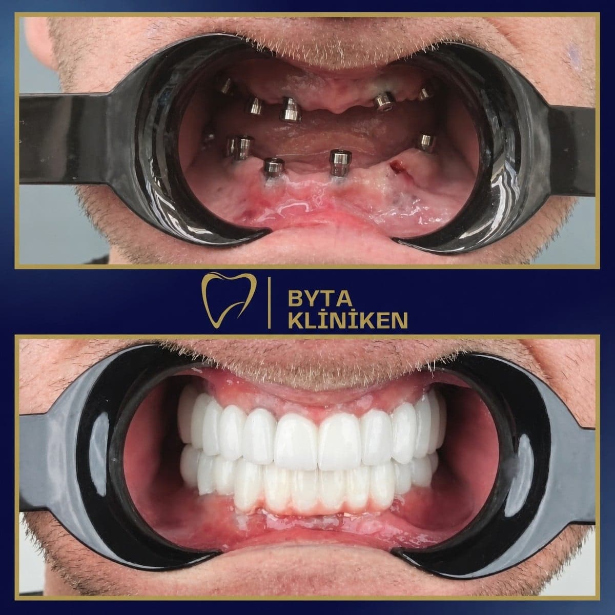 All-on-4 dental implants