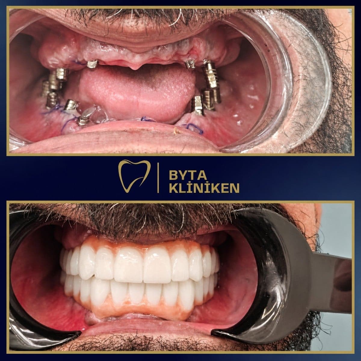 All-on-4 dental implants