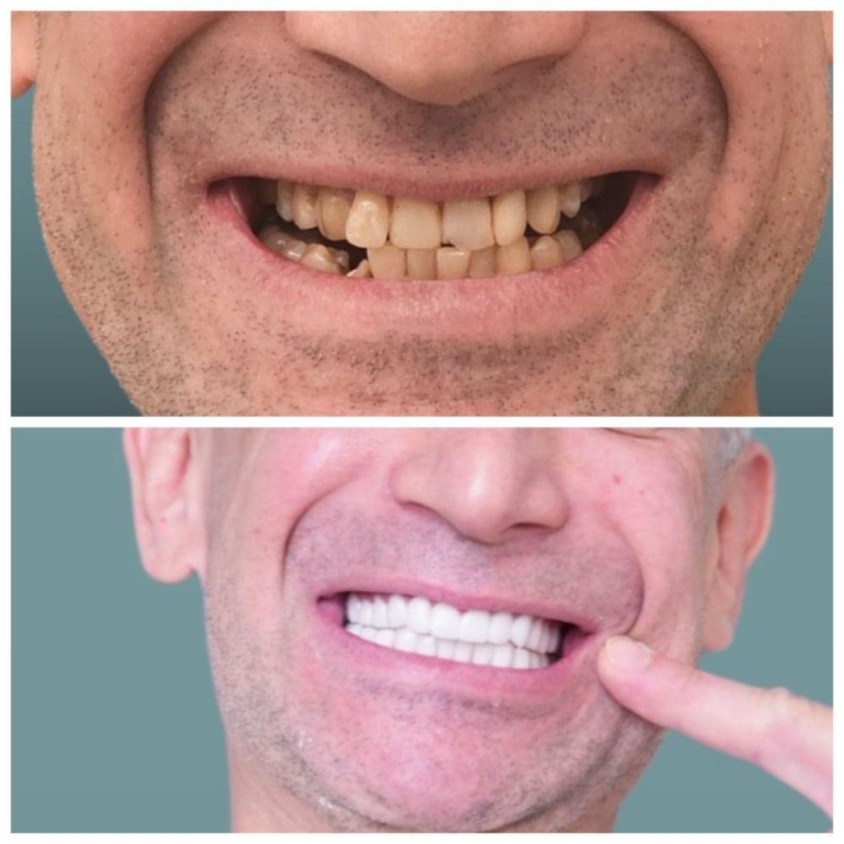 dental implant with crown