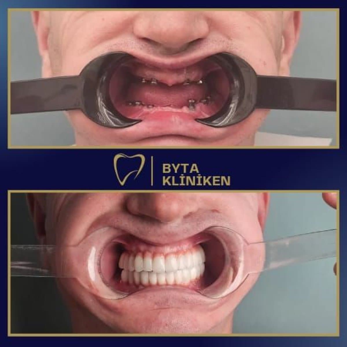 All-on-4 dental implants