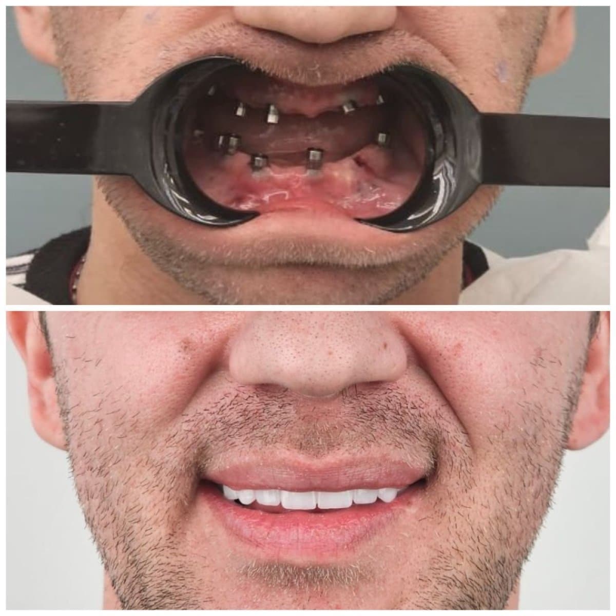 All-on-6 dental implants