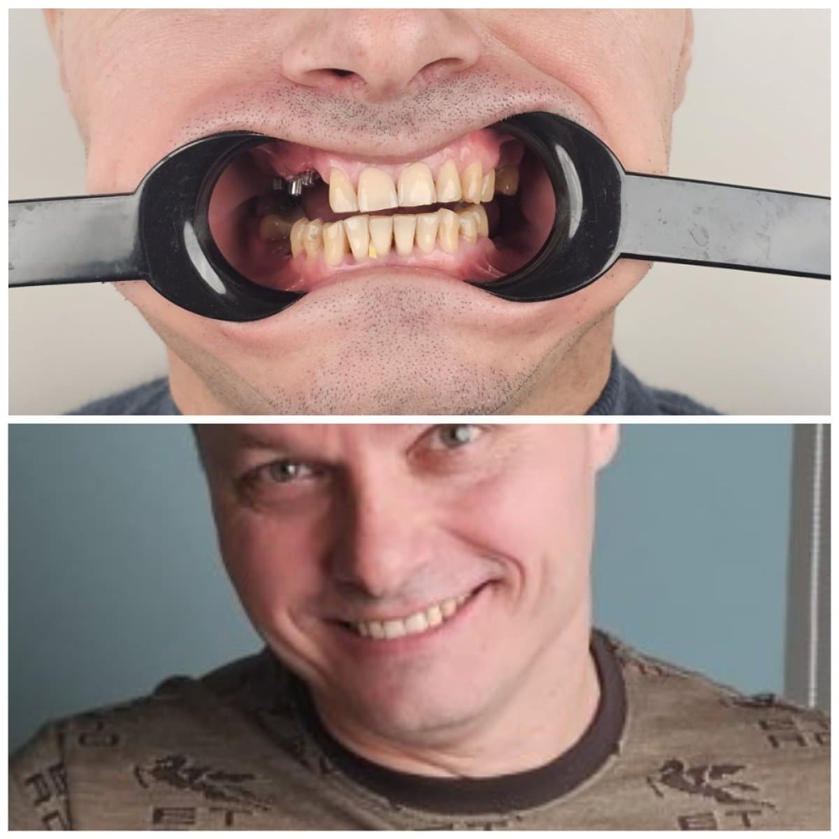 dental implant