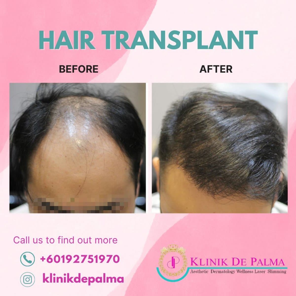 FUE hair transplant