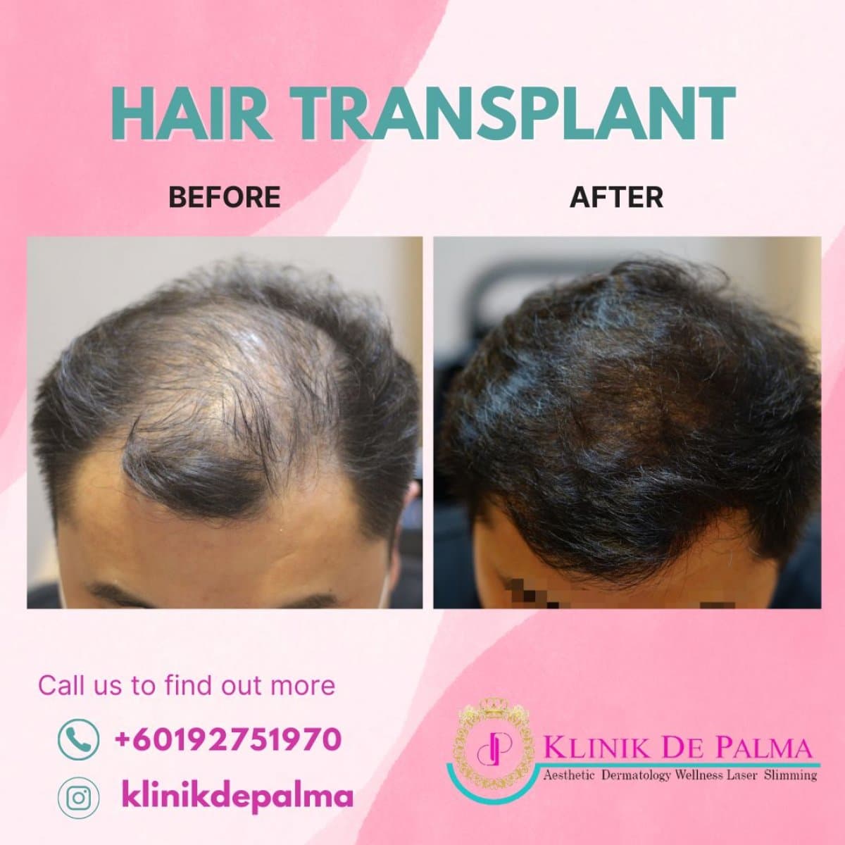 FUE hair transplant