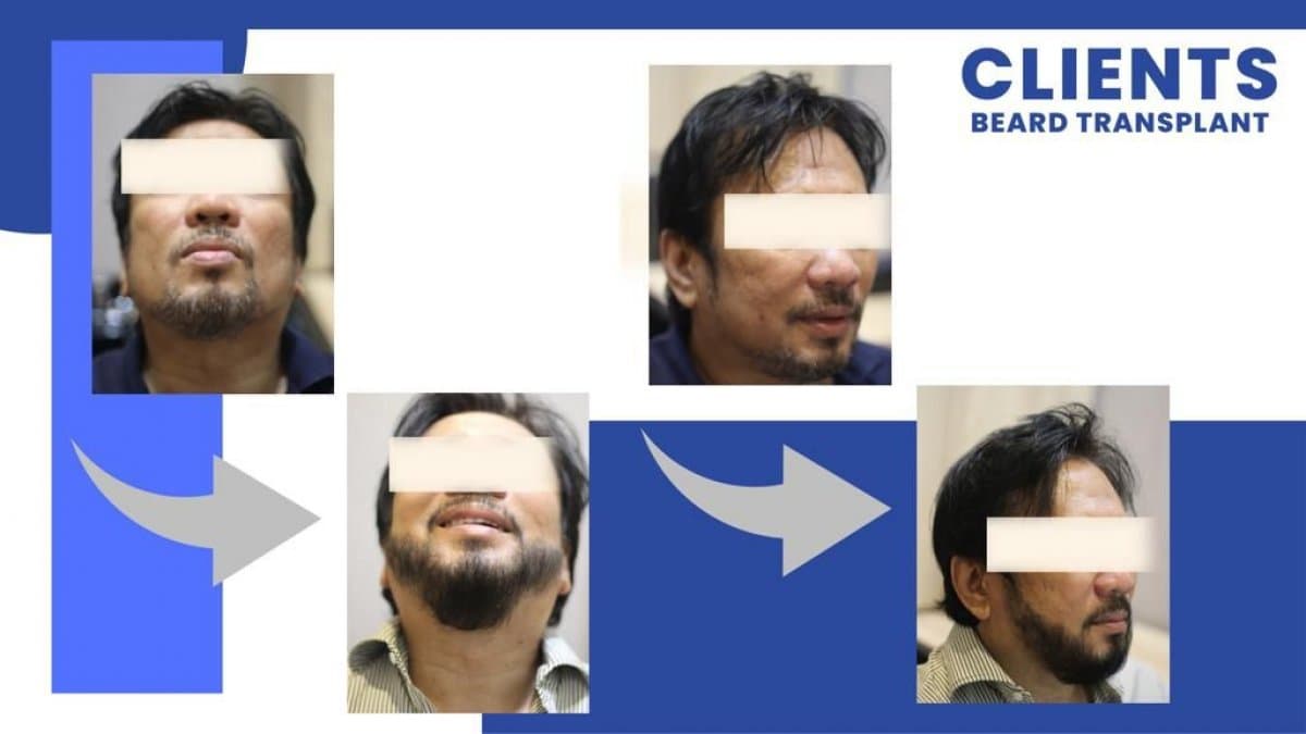 beard transplant