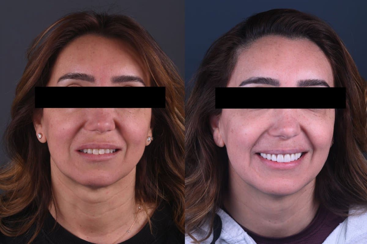 porcelain veneer
