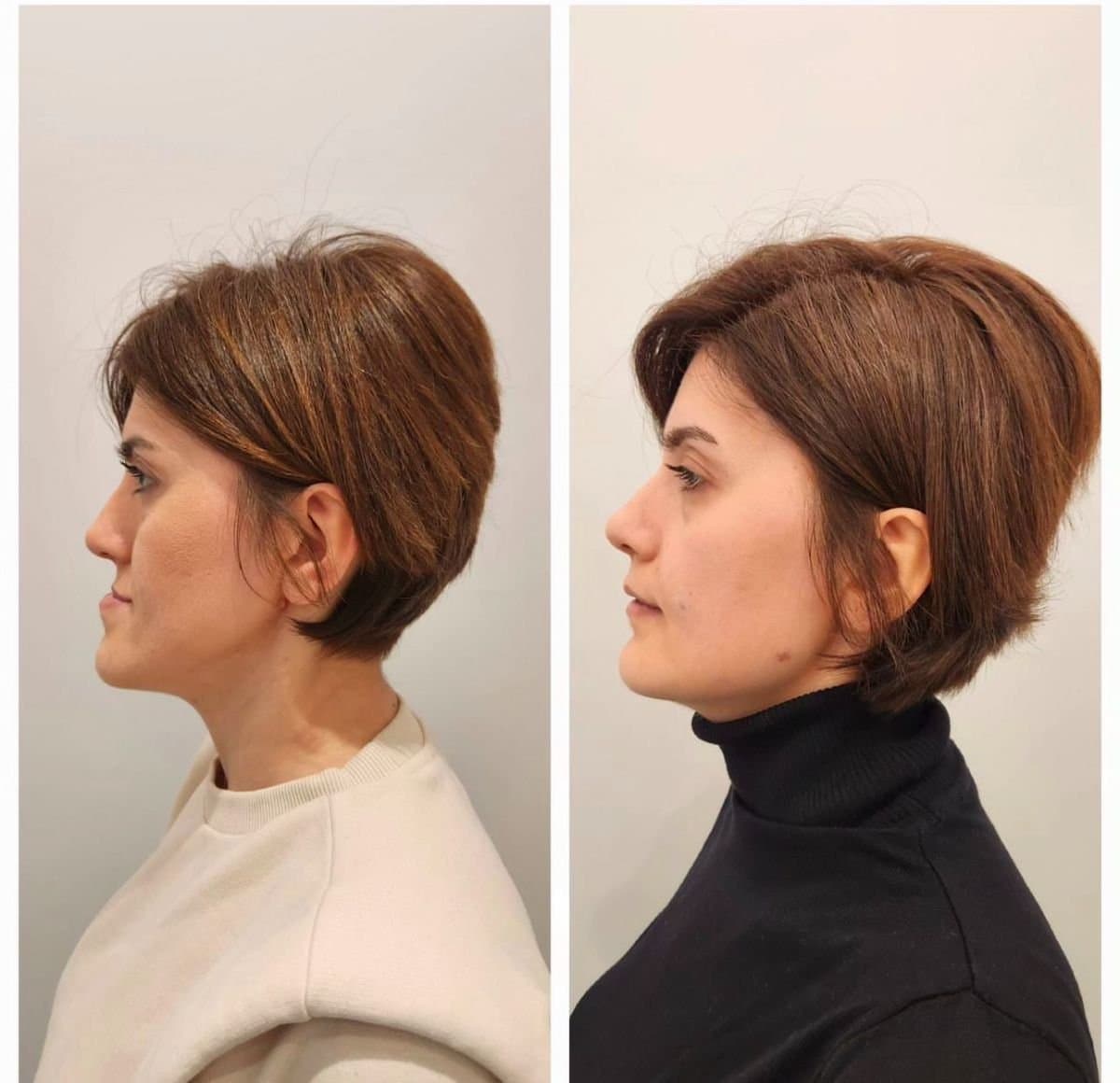sliding genioplasty