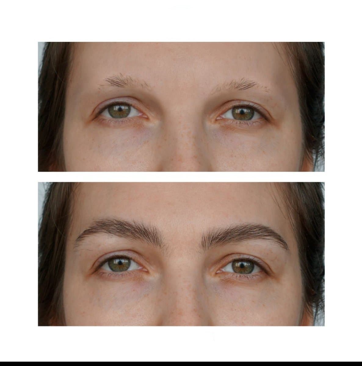 eyebrow transplantation