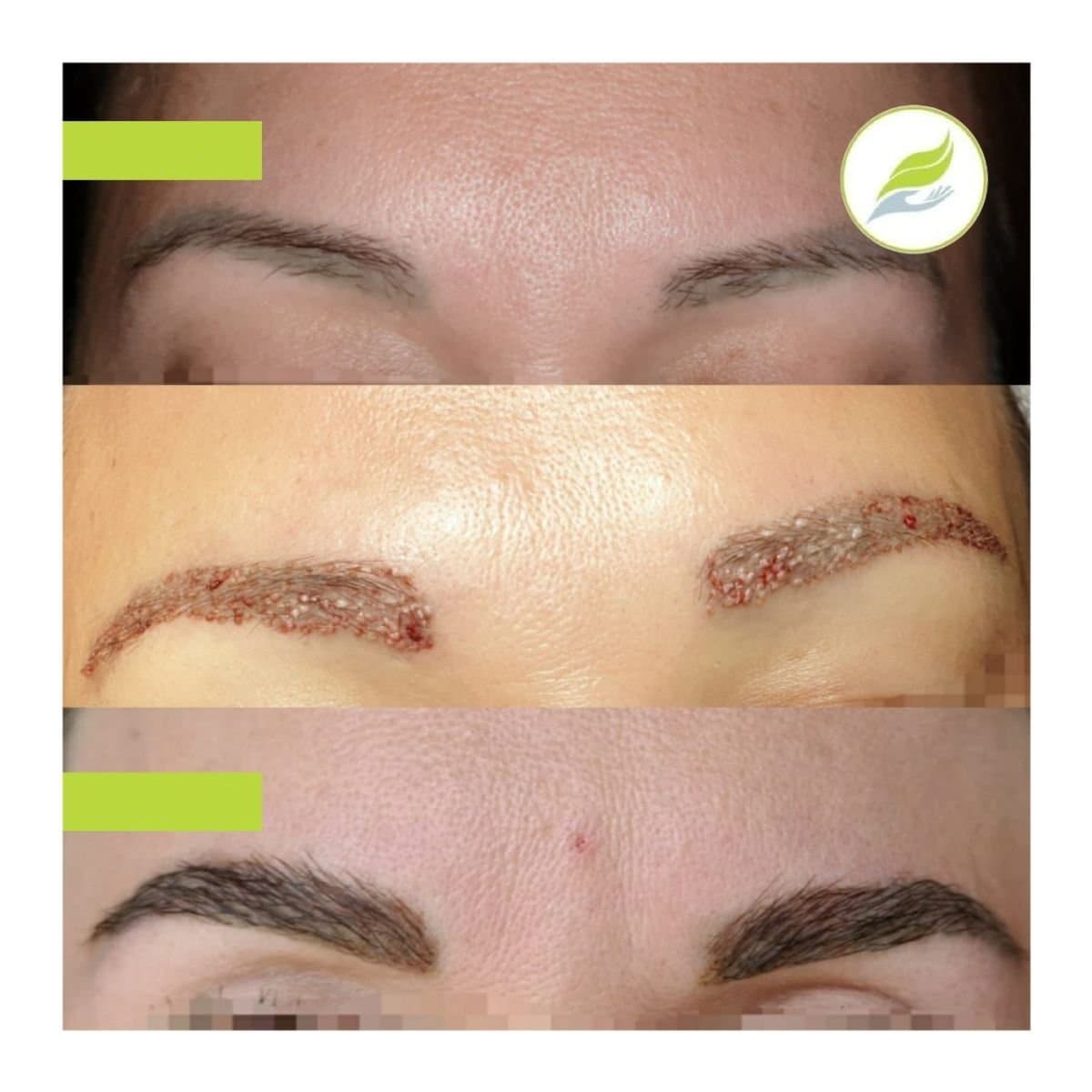 eyebrow transplantation