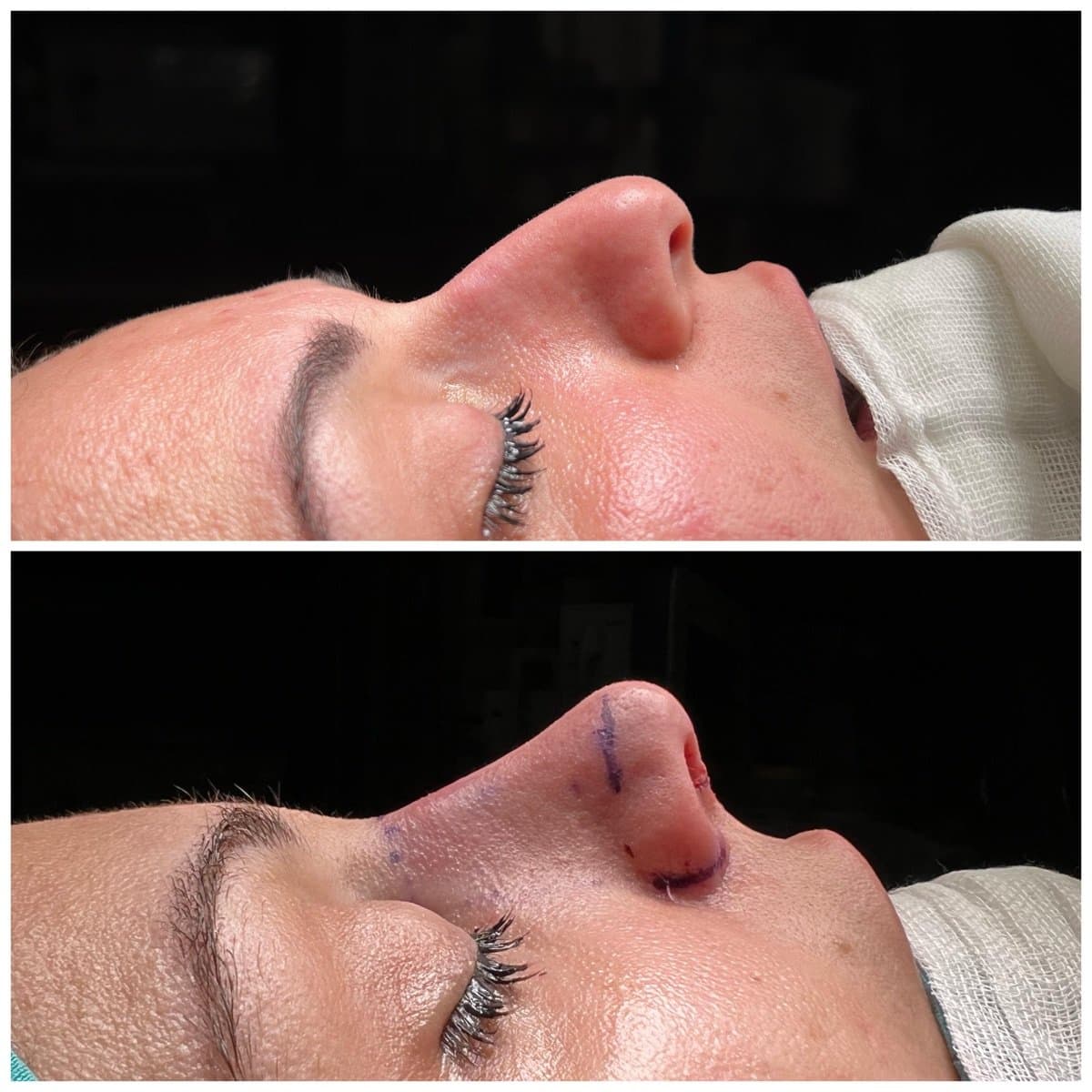 rhinoplasty