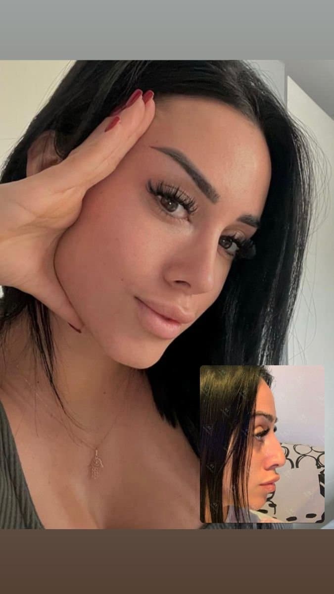 rhinoplasty