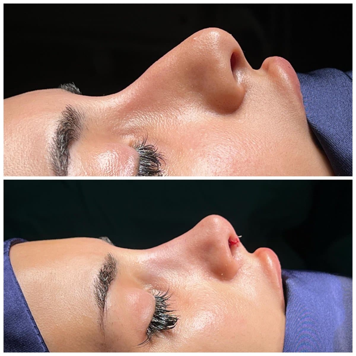 rhinoplasty